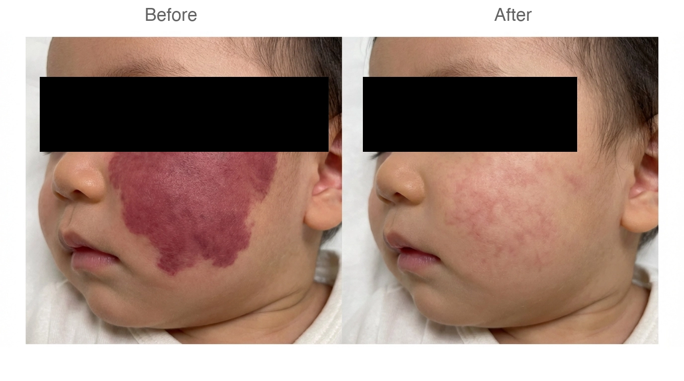 ポートワイン母斑(単純性血管腫)の症例 施術前と施術後